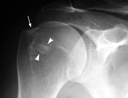 calcificacion-hombro1