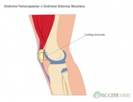 sindrome-femoropatelar